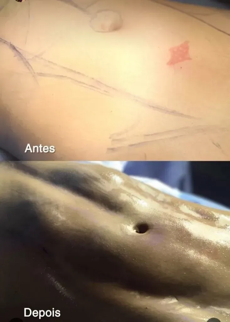 Ex-BBB Laís Caldas realiza cirurgia plástica na parte íntima e