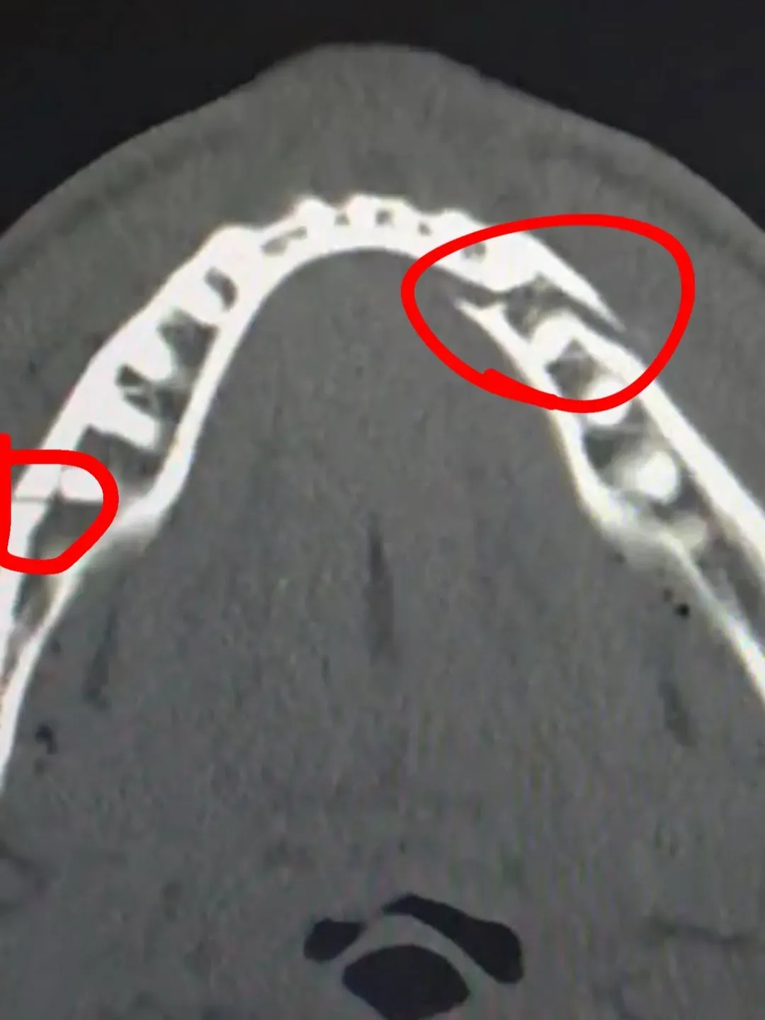 Anthony Joshua le fracturó la mandíbulo a Jake Paul.