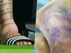 ¿Cuál estaba peor? Comparan el tobillo de Messi con el de Alexis