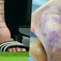 ¿Cuál estaba peor? Comparan el tobillo de Messi con el del Alexis Sánchez en la final del 2016