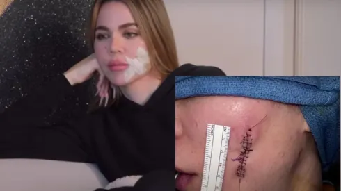 La estrella de Internet reveló cómo lucía su rostro tras la eliminación de un melanoma
