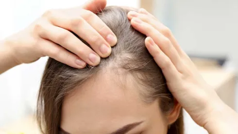 ¿De qué se trata la Alopecia y cuáles son los tratamientos?
