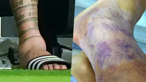 El tobillo de Lionel Messi vs el de Alexis Sánchez.
