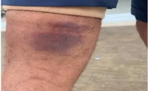 Marca na perna de Felipe Melo: zagueiro deve ser baixa por até 15 dias (Foto/reprodução)