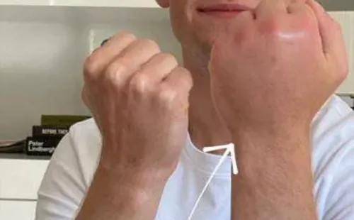 De Jong y su mano hinchada.