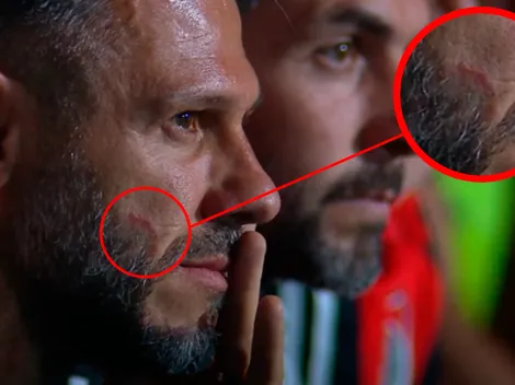 ¿Qué le pasó a Martín Demichelis en la cara?