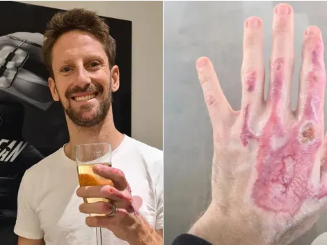 Romain Grosjean mostra mãos em recuperação após acidente: "Melhorando"