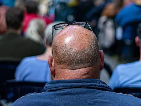 É normal perder cabelo diariamente? Especialista fala sobre saúde capilar e diz quais cuidados ter para evitar a calvície