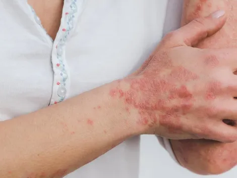 Ainda desconhecida por muitos, psoríase vem acompanhada de preconceitos; médico explica sobre a doença de pele