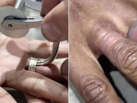Joalheiro tira aneis que permaneceram por 15 anos no dedo de mulher no Canadá