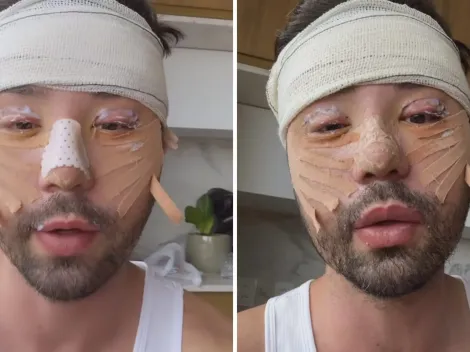 Rico Melquiades desabafa após receber críticas por cirurgia no rosto