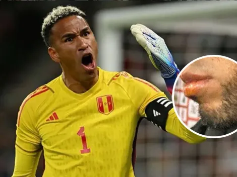 Selección Peruana: Así quedó el rostro Pedro Gallese tras impacto del balón en su rostro