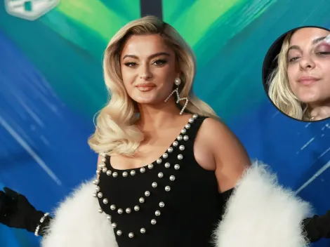 ¿Qué le paso a Bebe Rexha en el rostro?