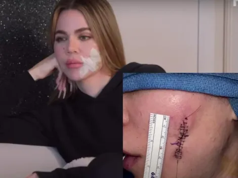 Khloé Kardashian revela sutura en la cara tras eliminación del melanoma