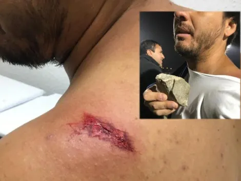 Hincha herido con una piedra en el Barnechea-Santa Cruz