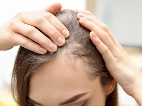 ¿De qué se trata la Alopecia y cuáles son los tratamientos?