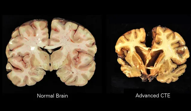 La diferencia entre un cerebro sano y un cerebro con CTE (foto: Wikipedia)