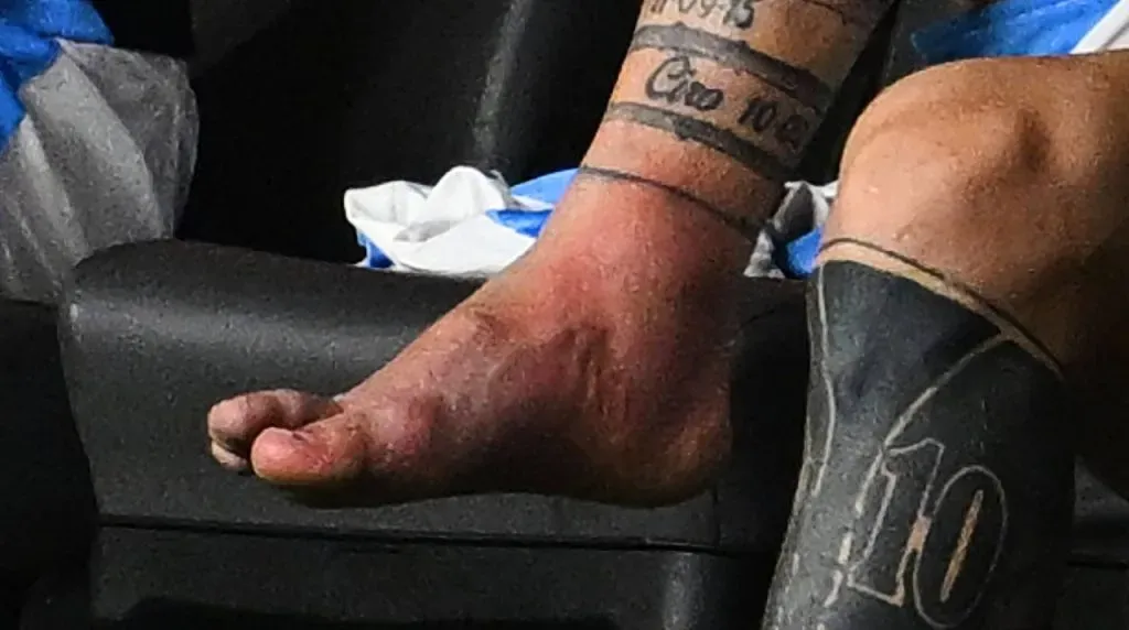 El tobillo de Messi tras lesionarse en la Copa América. (Foto: Imago)