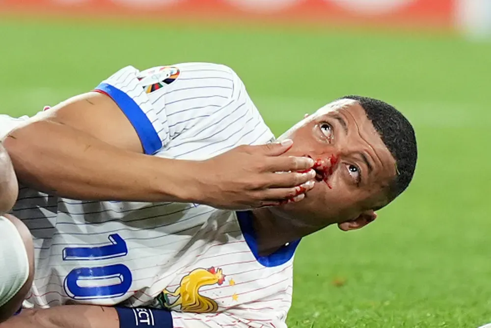 Mbappé no se baja de Francia por la fractura nasal y jugará el resto de la Eurocopa con máscara. ¡Pónganle una morada a Donatello!