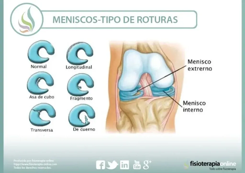 El menisco consta de tres partes y las lesiones pueden producirse de manera externa o interna.