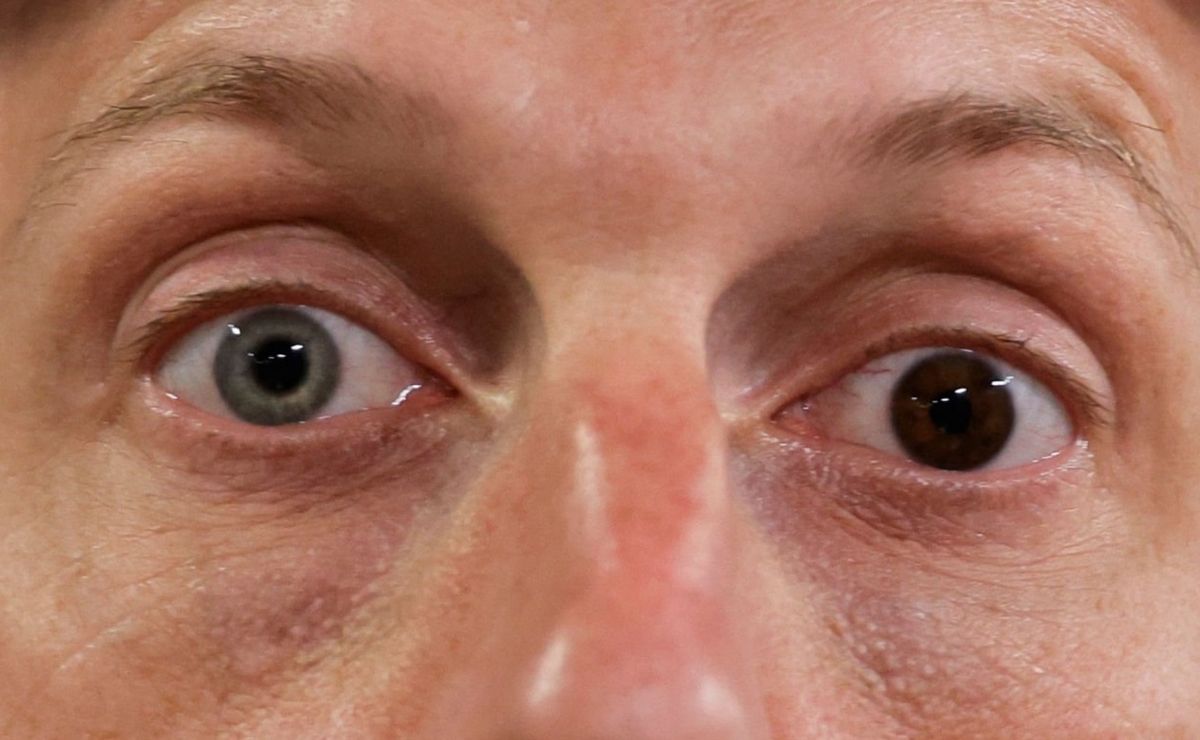 Max Scherzer's Heterochromia Why Do His Eyes Have Different Colors