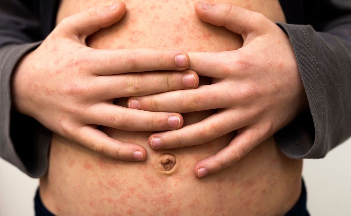 Imported measles case in Malaysia confirmed: Is it dangerous?