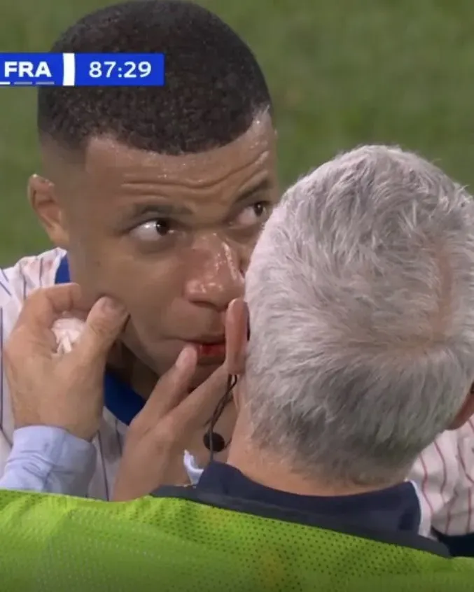 Así quedó el rostro de Mbappé. (Foto: ESPN)