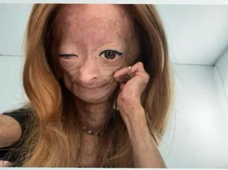 Morre Adalia Rose, youtuber de 15 anos; menina sofria com a doença de "Benjamin Button"