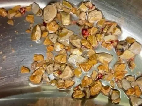 Médicos removem 206 pedras dos rins de paciente