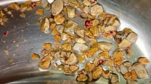 Médicos removem 206 pedras dos rins de paciente. Imagem: Reprodução.