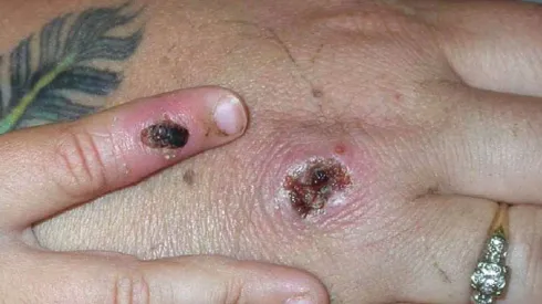 O caso é considerado importado, porque o homem tem histórico de viagem à Portugal e Espanha