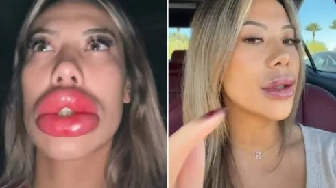 Basia Query durante e depois da reação alérgica que teve nos lábios