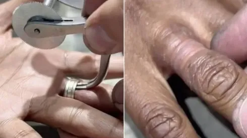 Mulher tira anéis que ficaram presos em seu dedo por mais de 15 anos