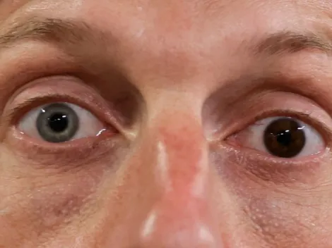 Max Scherzer's Heterochromia: Why Do His Eyes Have Different Colors?