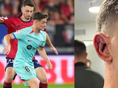 Impactante: Así quedó la oreja de Gavi tras Osasuna vs. FCB