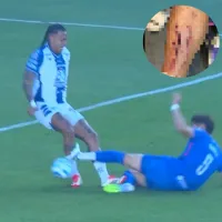 Impactante imagen: el estado de la pierna del Chiquete Orozco tras su roja ante Pachuca