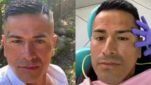 Kike Acuña se aplicó botox para rejuvenecer
