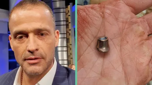 Iván Núñez y la bala que irió uno de sus brazos en el ataque del que fue víctima su equipo.