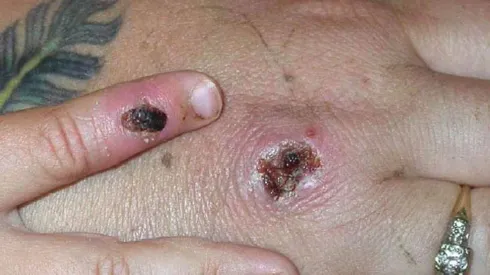 Viruela del mono: Argentina detectó primer caso sospechoso de la enfermedad