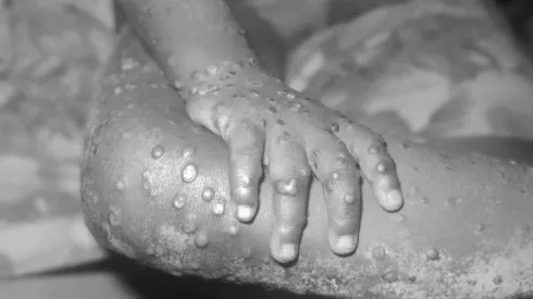 ¿Cómo se contagia la Viruela del Mono y existe un tratamiento o vacuna?