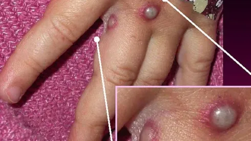 Ministerio de Salud envía alerta epidemiológica a Seremis de Salud por Viruela del Mono