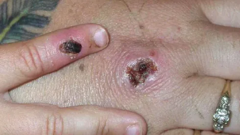 Viruela del mono | ¿Puede convertirse en pandemia como el Covid-19?