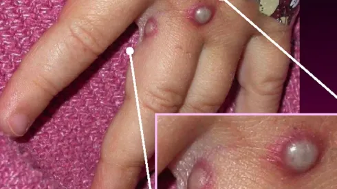 Lesiones provocadas por la viruela del mono.