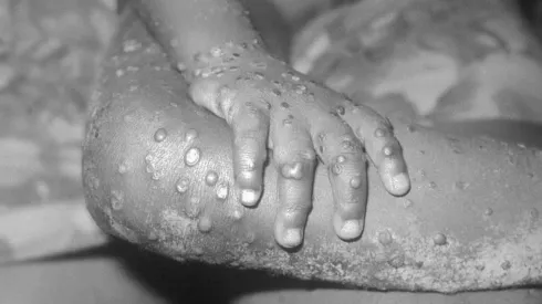 OMS: es "poco probable" que viruela del mono se convierta en pandemia