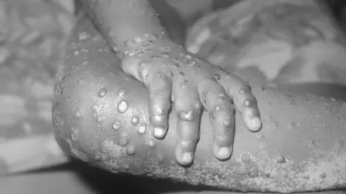 ¿En qué países se han detectado casos de la Viruela del Mono?