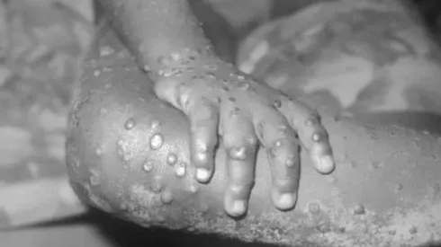 La Viruela del Mono cambiará su nombre