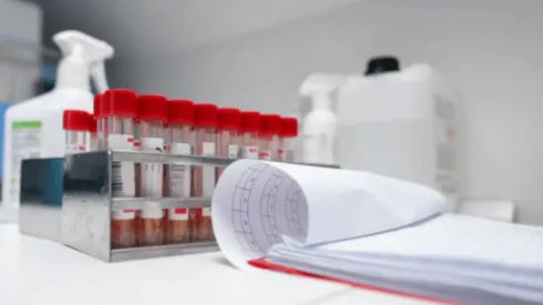 Viruela del Mono en Chile