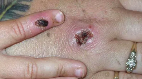 La Viruela del Mono suma su tercer caso en Chile.