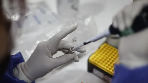 ¿Cuáles son los protocolos en caso de contagiarse con la Viruela del Mono?