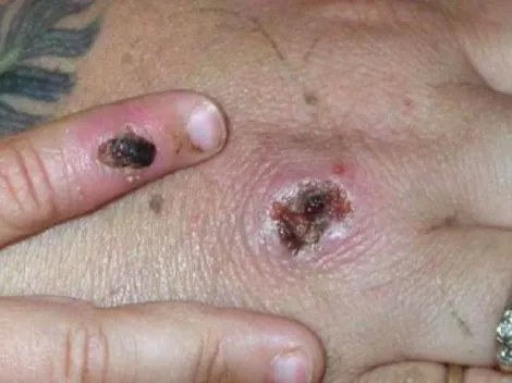 OMS descarta Emergencia Internacional por viruela del mono